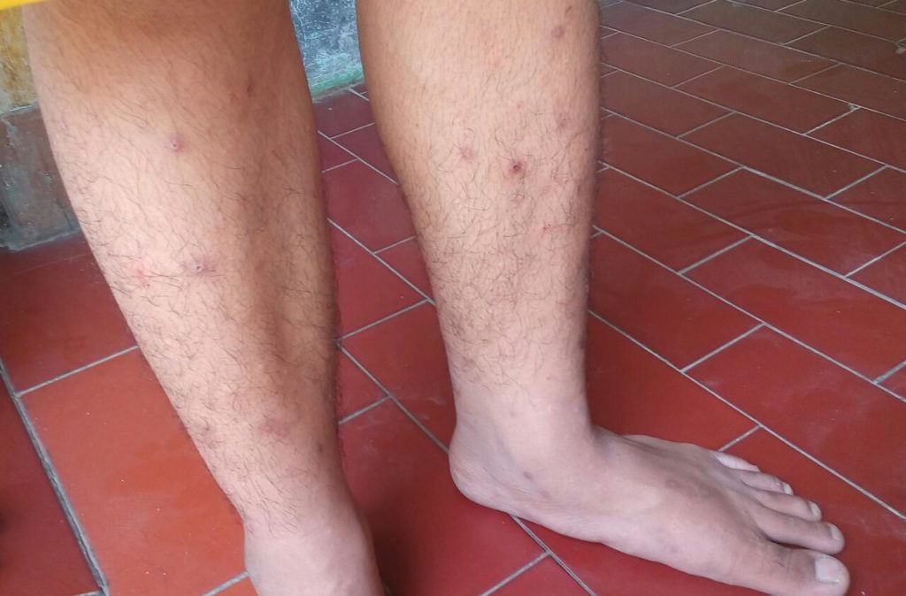 wabah penyakit kulit 